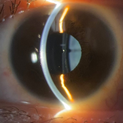 Read more about the article Refractive surgery follow-up