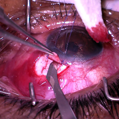 Read more about the article The case for trabs: ‘Trabeculectomy is not dead’