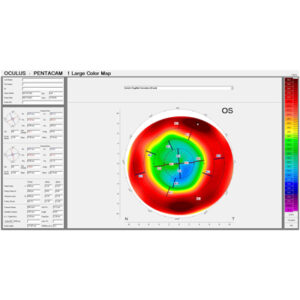 Read more about the article The role of corneal imaging for IOL planning