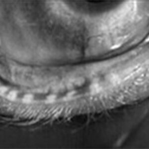 Read more about the article A breakdown of evaporative and aqueous tear deficient dry eye