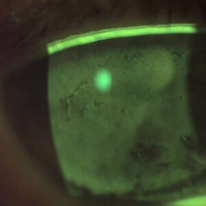 Read more about the article Optimizing the ocular surface in the context of glaucoma