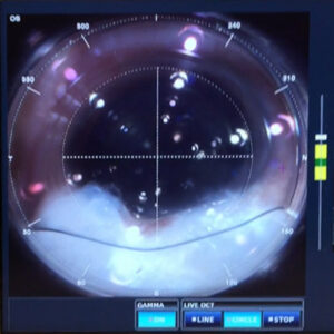 Read more about the article A perspective on FLACS and glaucoma