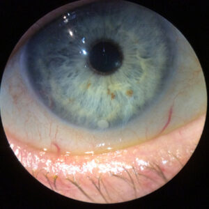 Read more about the article Innovation changing the philosophy of glaucoma treatment