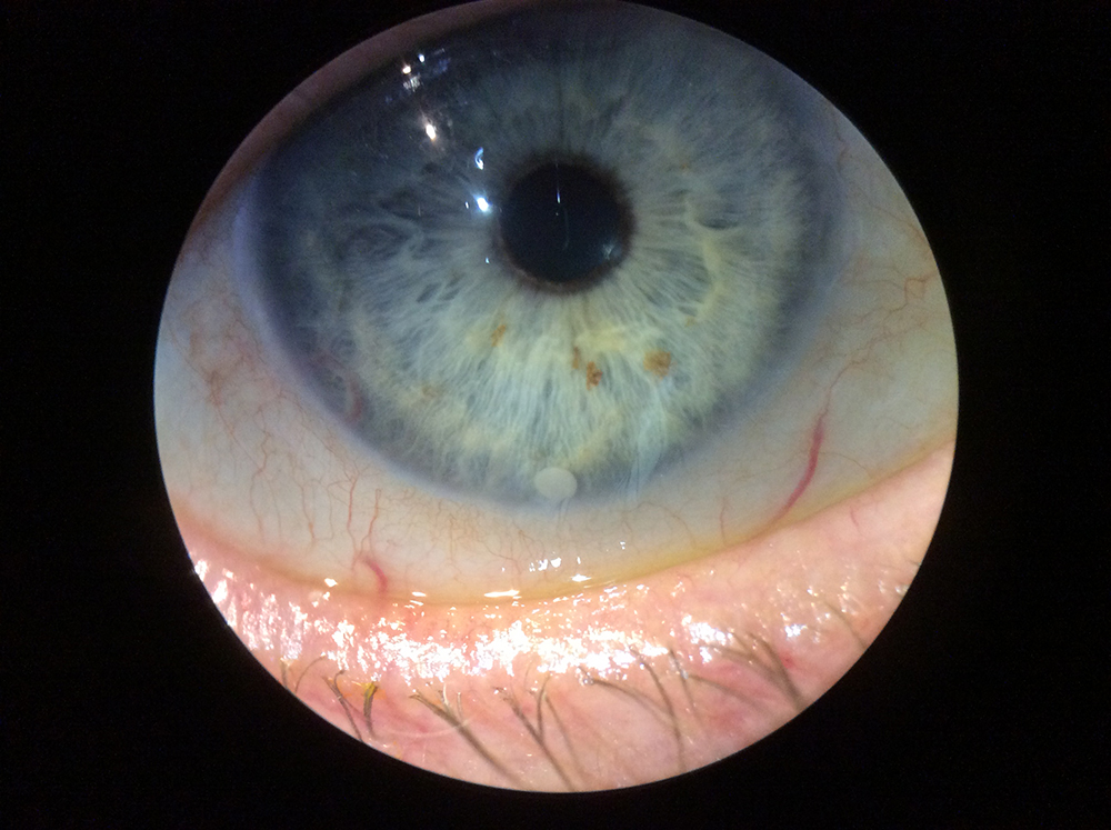 Well-positioned Durysta in the anterior chamber along the inferior angle and taking spherical configuration (which occurs about 20% of time)
Source: Savak Teymoorian, MD