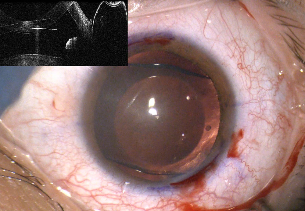 The EVO ICL pre- and post-rotation to 90 degrees Source: Roger Zaldivar, MD