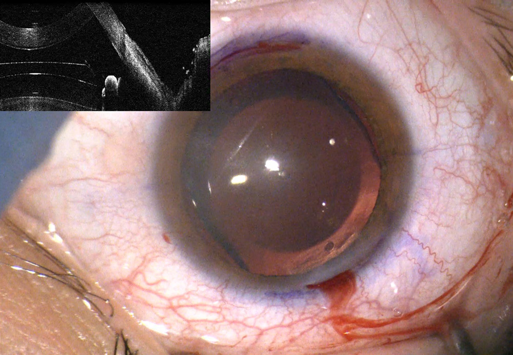The EVO ICL pre- and post-rotation to 90 degrees Source: Roger Zaldivar, MD