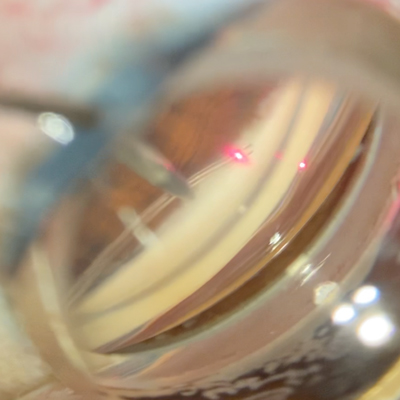 Read more about the article Combining MIGS procedures