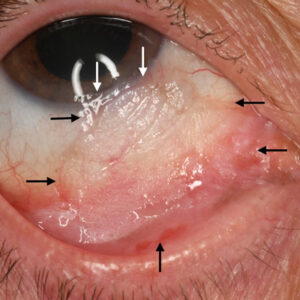 Read more about the article The latest in the treatment of OSSN