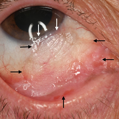 Read more about the article The latest in the treatment of OSSN