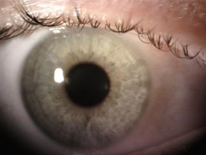 Day 1 postop photo of SMILE
Source: Audrey Talley Rostov, MD