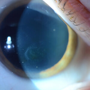 Read more about the article Debating the best way to manage recurrent corneal erosions