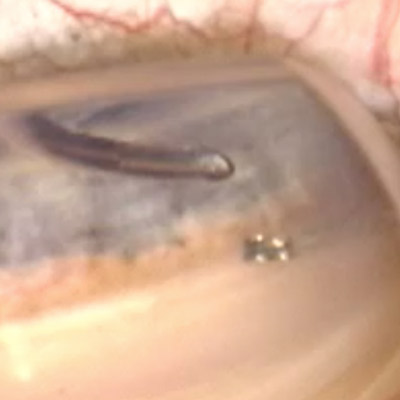 Read more about the article Study: MIGS implant helps preserve visual fields 