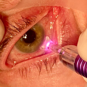 Read more about the article MicroPulse for the anterior segment surgeon