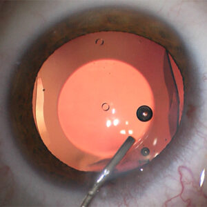 Read more about the article The EVO ICL: What makes it different and results