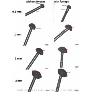 Read more about the article Achieving optimal flange size for intrascleral haptic fixation