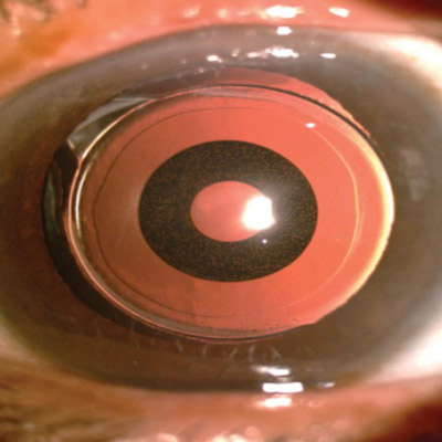 Read more about the article New IOLs offer option of ‘blended vision’