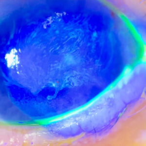 Read more about the article How vaccines may affect the cornea