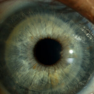 Read more about the article The status of DSAEK and DMEK