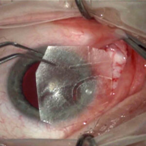 Read more about the article Amniotic membrane: when it’s useful vs. overused