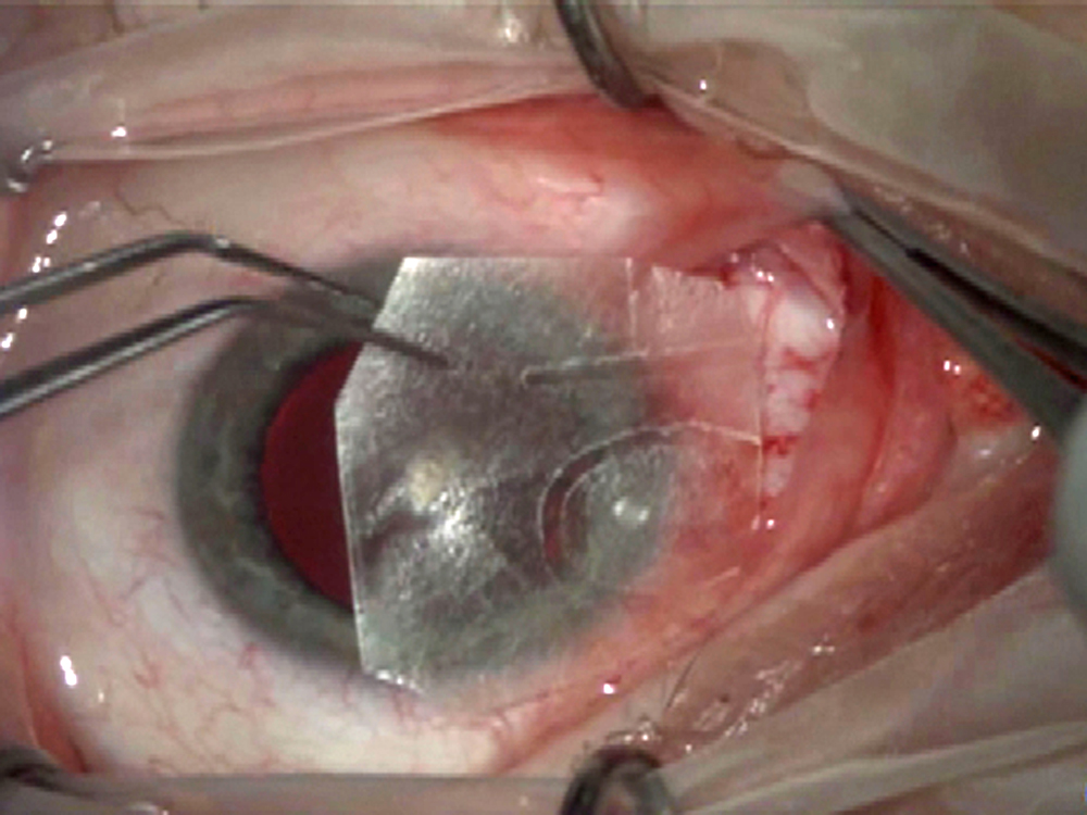 Placement of dehydrated amniotic membrane as a graft after pterygium removal Source: John Hovanesian, MD
