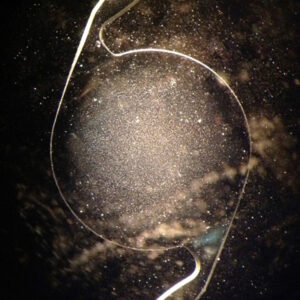 Read more about the article Potential issues after cataract surgery