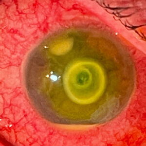 Read more about the article An update on corneal ulcer management