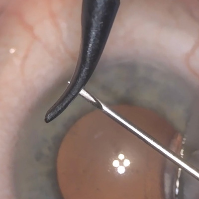 Read more about the article MIGS and IOP control