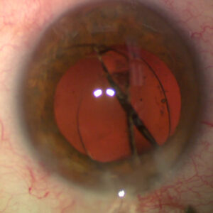 Read more about the article IOL exchange 101