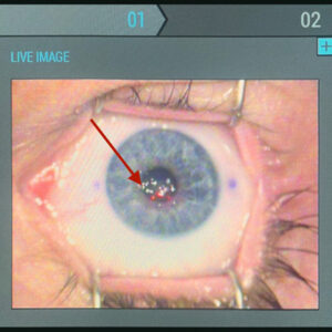 Read more about the article Observation: epithelial loosening potentially associated with prior COVID-19 infection