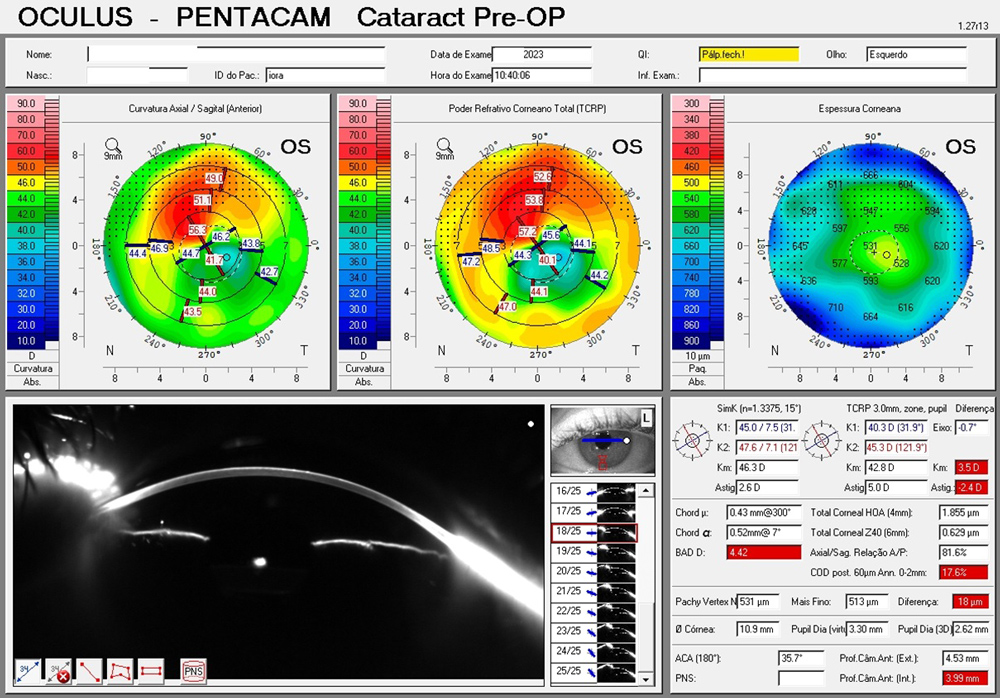 Figure 2. Scheimpflug tomography; irregular astigmatism has a similar pattern as in Figure 1; the thickness map indicates thickening in the steeper zone, which does not resemble an ectatic pattern Source: Renato Ambrosio Jr., MD, PhD