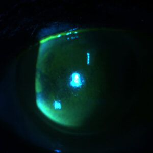 Read more about the article Optimizing the glaucoma eye for surgery