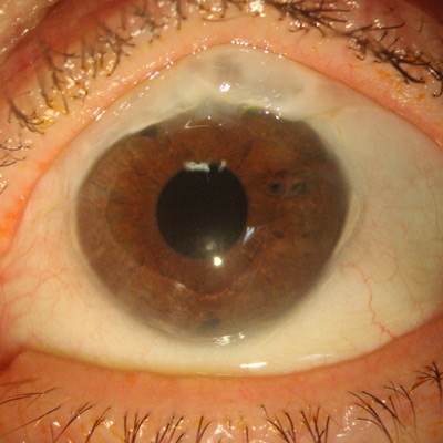 Read more about the article Special considerations for DMEK in glaucoma patients