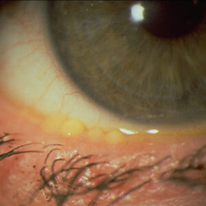 Read more about the article Blepharitis: types, presentation, and treatment