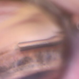 Read more about the article Navigating the world of goniotomy/trabeculotomy and canaloplasty