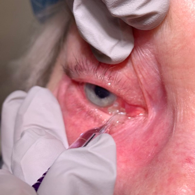 Read more about the article Consensus guidelines published for MicroPulse Transscleral Laser Therapy