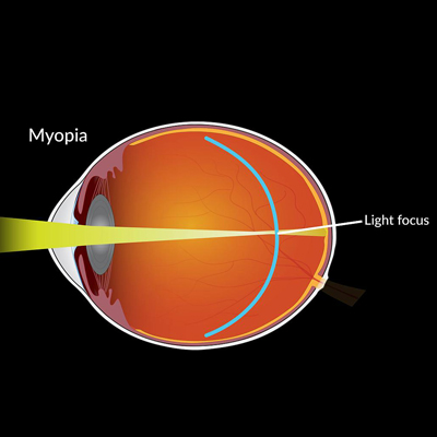 Read more about the article ‘Mixed results’ of low-dose atropine for myopia