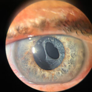 Read more about the article Posterior capsulotomy: history of using the YAG laser and best practices