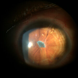 Read more about the article How to handle uveitic glaucoma