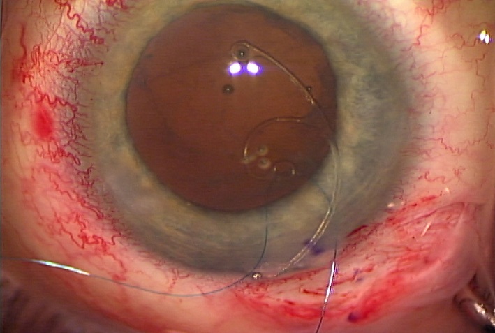 Ahmed capsular tension segment that has just been inserted into the eye; it has a 9-0 Prolene suture threaded through the fixation element