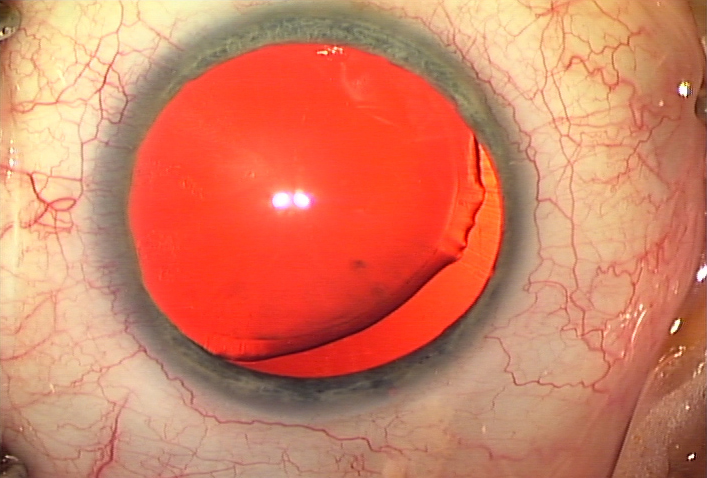 Traumatic zonular dialysis
