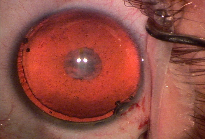 Weakened and stretched zonules Source (all): John Hart Jr., MD