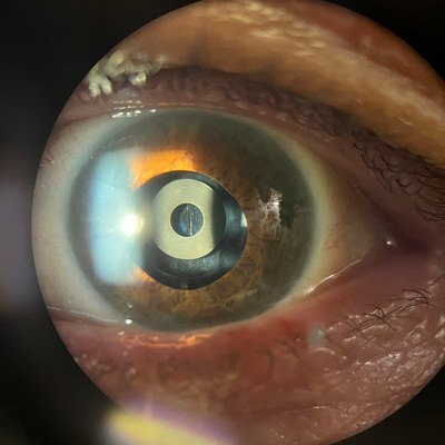 Read more about the article Incorporating the IC-8 Apthera into practice