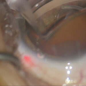 Read more about the article Common complications associated with MIGS