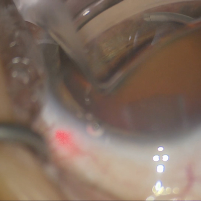 Read more about the article Common complications associated with MIGS