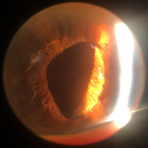 Read more about the article Yamane complications and management pearls