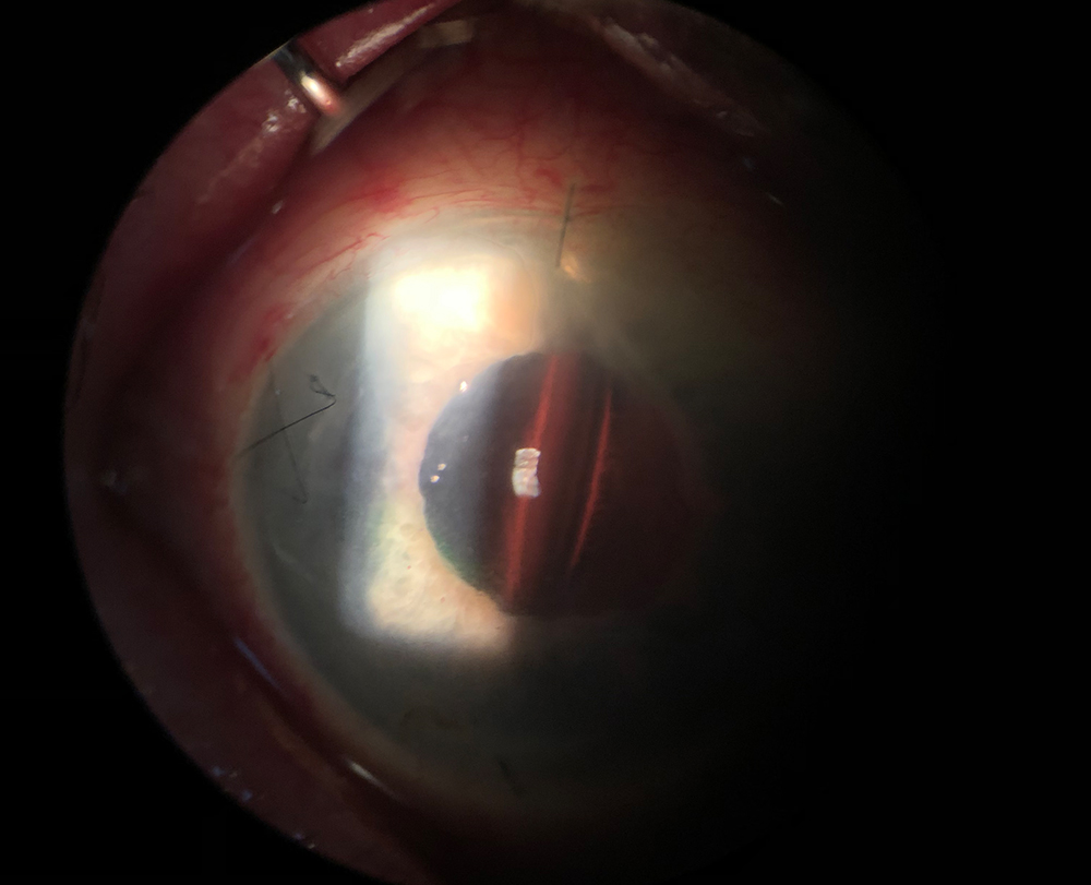 Figure 2: Lens tilt or decentration can occur due to a variety of reasons during intrascleral haptic fixation, especially asymmetry of the scleral tunnels.