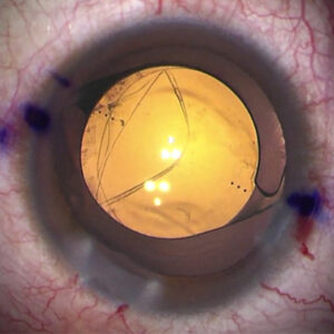 Read more about the article What to do? A compromised capsule when a toric IOL was planned