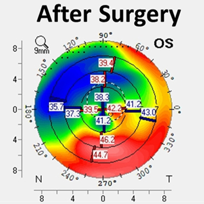 Read more about the article Management and options for patients with post-refractive ectasia