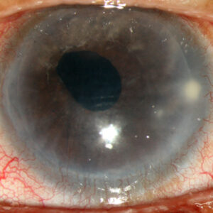 Read more about the article Handling lamellar graft infections