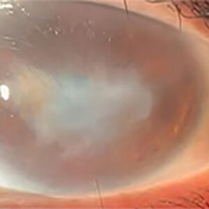 Read more about the article Losartan for the cornea, conjunctiva, glaucoma, and beyond